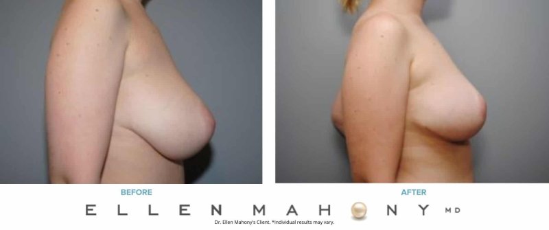 Breast implant, Before and after breast augmentation, Before after