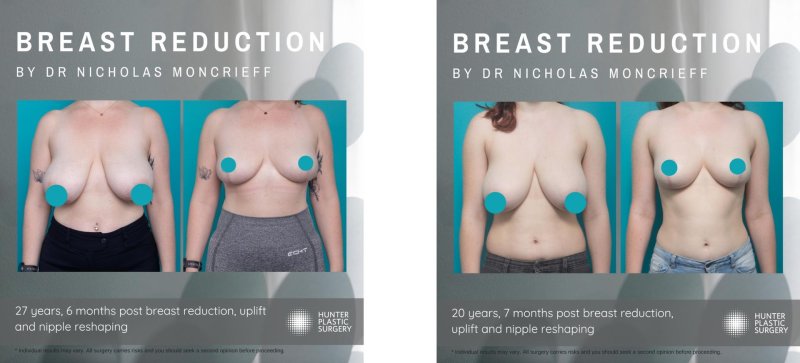 Breast reduction, Breast augmentation, C cup breast