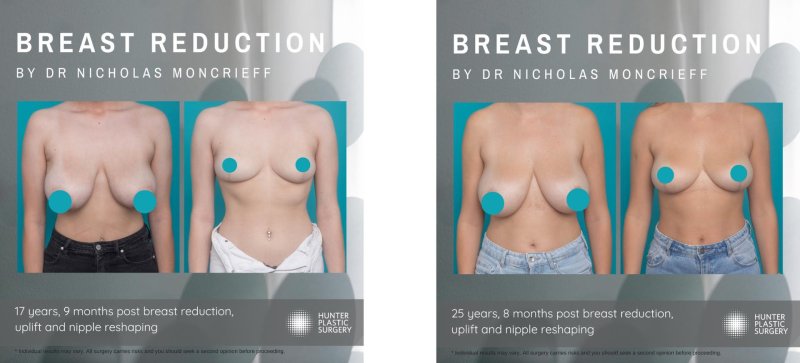 Breast reduction, Breast augmentation, C cup breast