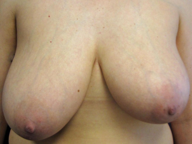 Periarelar mastopexy, Anchor reduction mammoplasty, Breast reduction