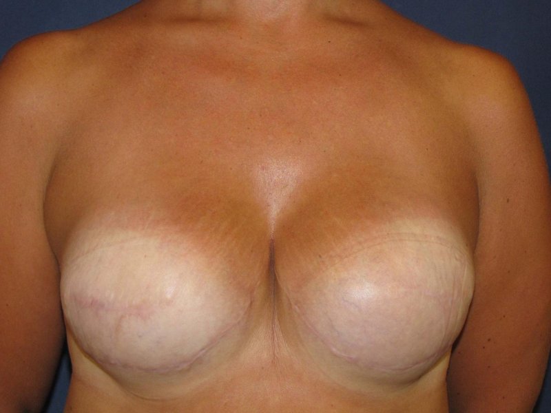 Breast plastic, Breast enlargement, Breast enlargement before and after