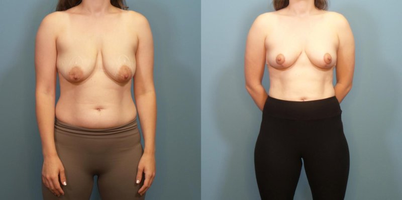 Breast plastic, Breast enlargement, Breast implants