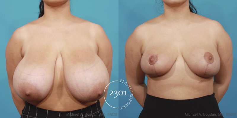Mammoplasty gigantomastia, Breast reduction, Reduction of breast Operation