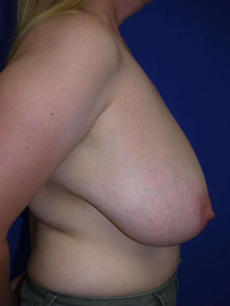 Breast reduction, Breast augmentation, Breast reconstruction