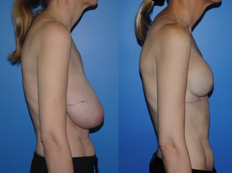 Breast augmentation, Operation on breast augmentation, Before and after breast augmentation