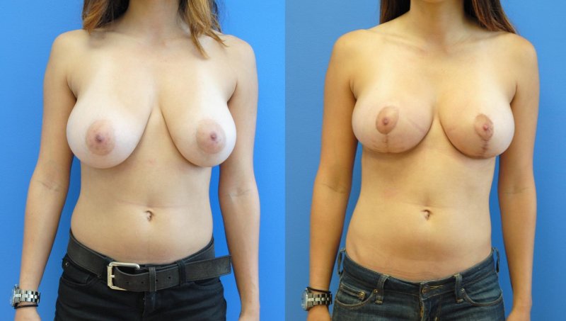 Breast augmentation, Breast plastic, Breast reduction