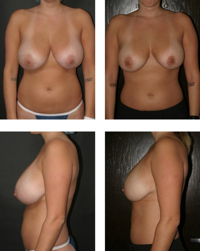 Breast reduction, Reduction mammoplasty, Gynecomastia degrees