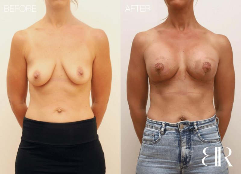 Breast augmentation, Breast plastic, Before and after breast augmentation