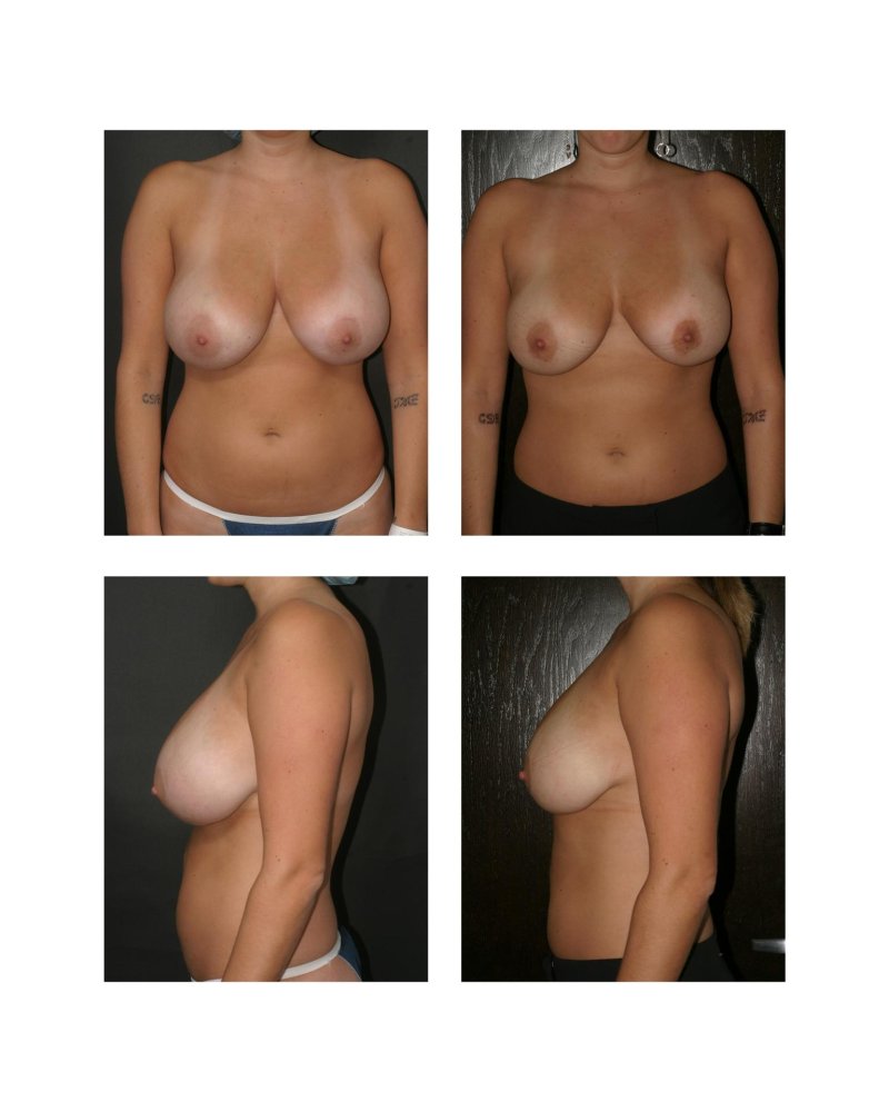 Breast reduction, Before and after breast augmentation, Breast enlargement
