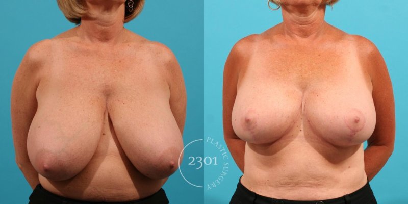 Breast reduction, Breast augmentation, Breast reduction dr richard