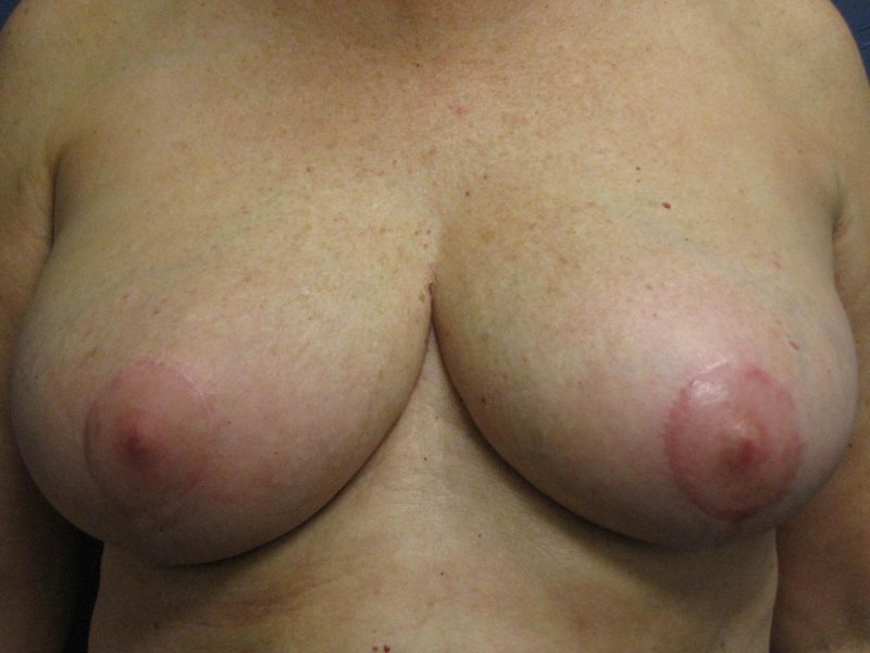 Anchor reduction mammoplasty, Periareolar mastopexy, Breast reduction