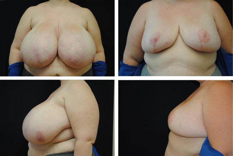 Breast plastic, For breast augmentation, Reducing the pectoral glands