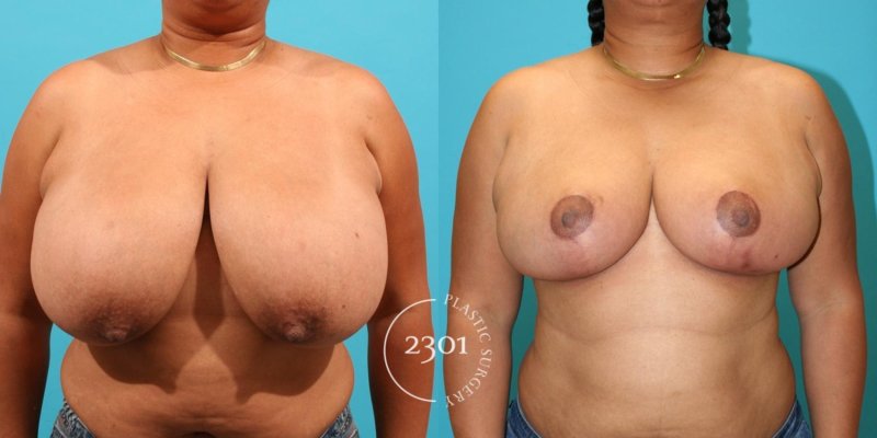 Breast reduction, Gynecomastia, Siski