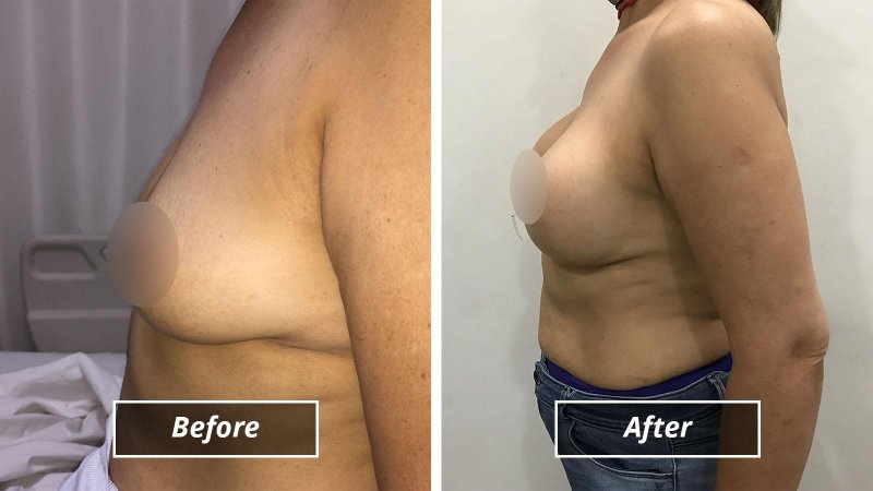 Breast augmentation, Breast plastic, Breast reduction