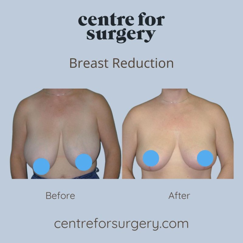 Breast reduction, Breast augmentation, Breast surgery