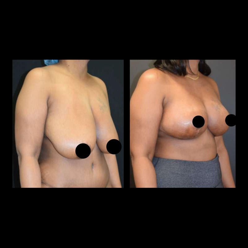 Breast reduction, Breast plastic, Breast lift