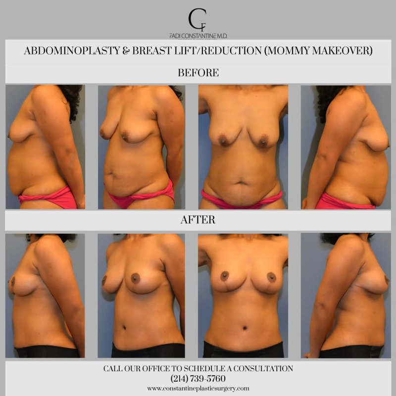 Breast lift, Breast reduction, Breast Reconstruction after Mastectomy