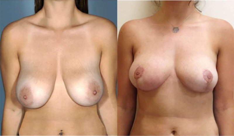 Breast reduction dr richard, Breast reduction, Breast plastic