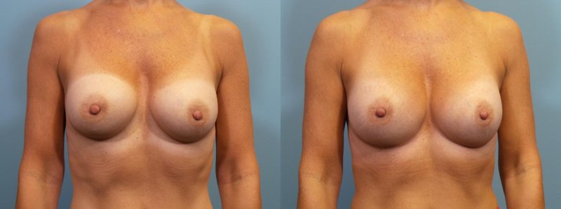 Breast augmentation, Breast reduction dr richard, Nikki benz before and after breast enhancement