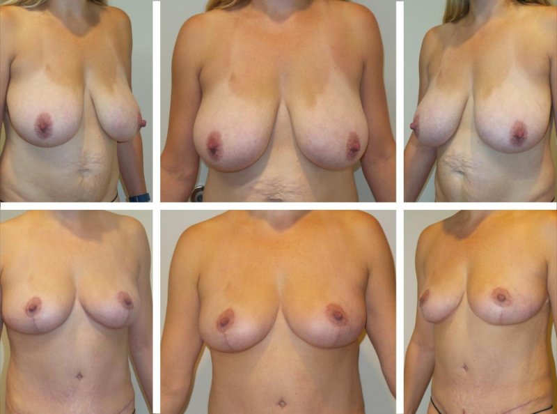 Breast reduction, Breast surgery, Breast augmentation