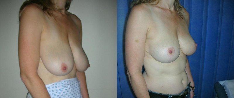 Breast reduction dr richard, Breast reduction, Brows