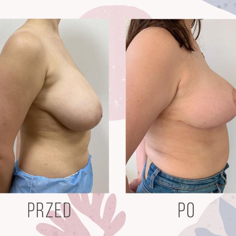 Breast enlargement, Breast reduction, For breast augmentation