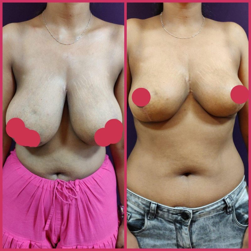 Breast augmentation, For breast augmentation, Breast plastic