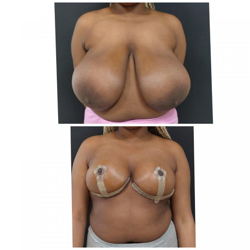 Breast reduction, For breast augmentation, Breast plastic