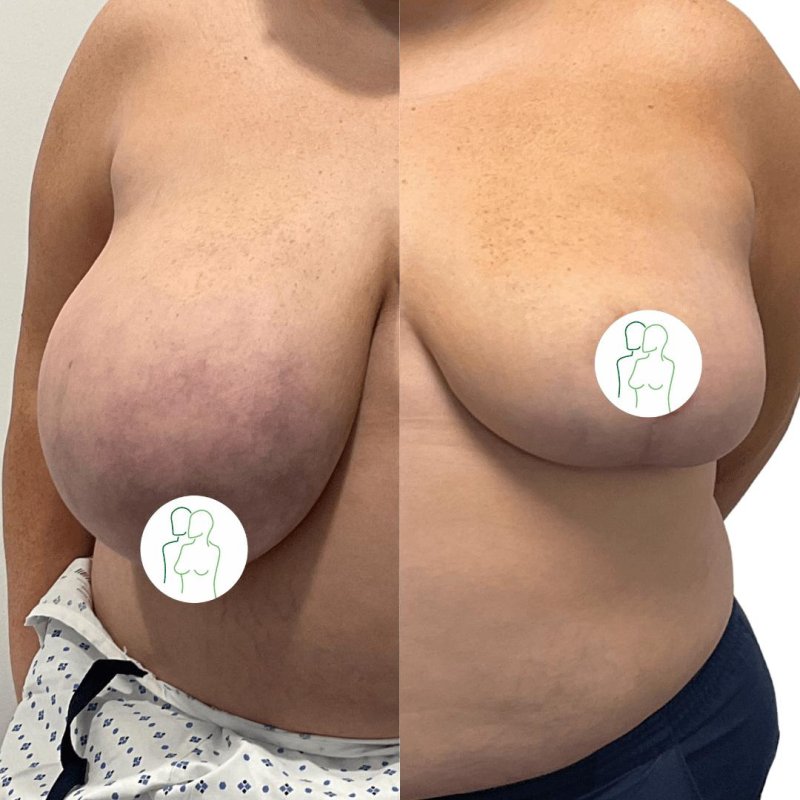 Breast reduction, Reduction mammoplasty, Breast plastic