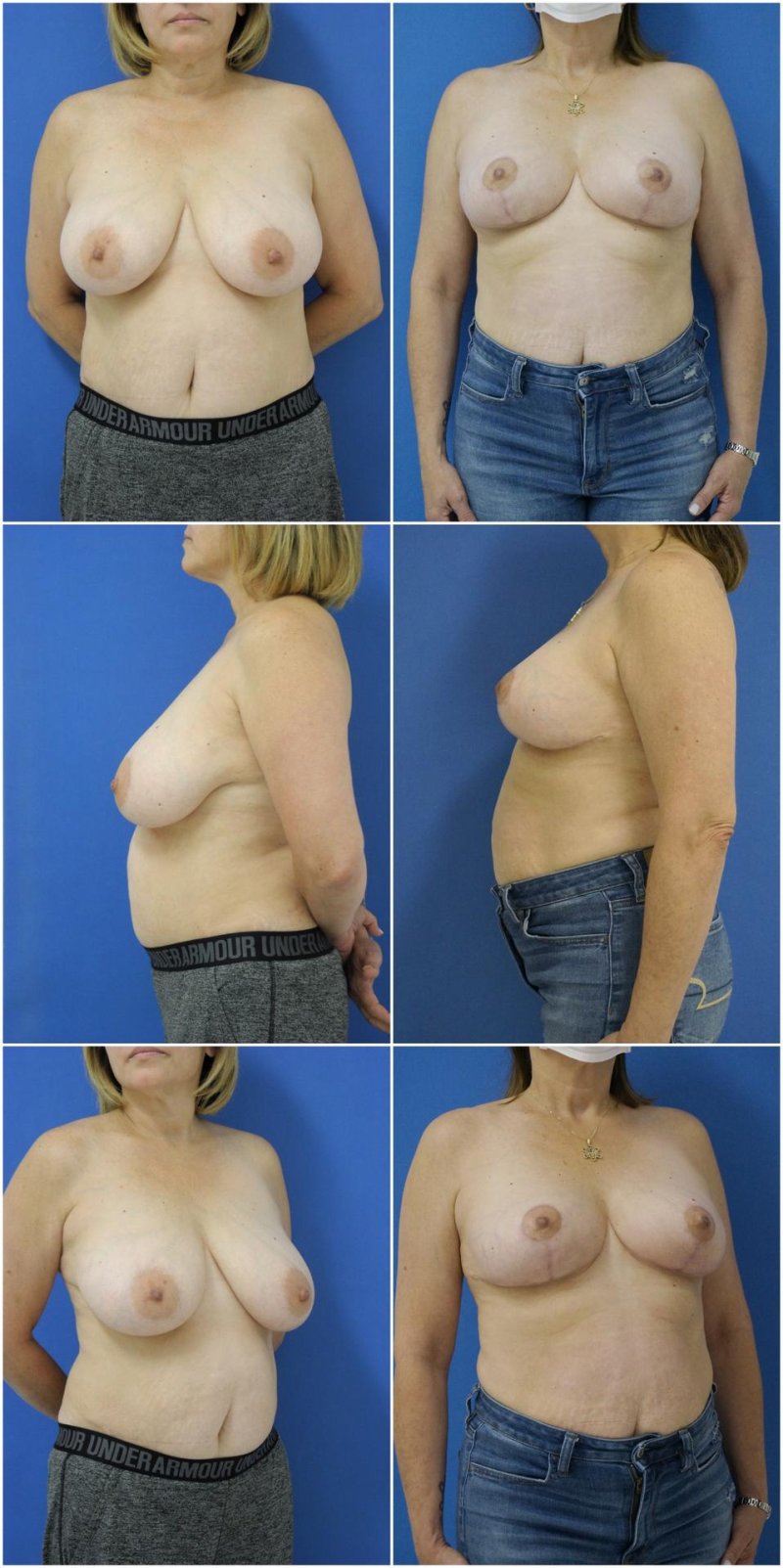Patiol gynecomastia, Breast enlargement in men, Breast reduction