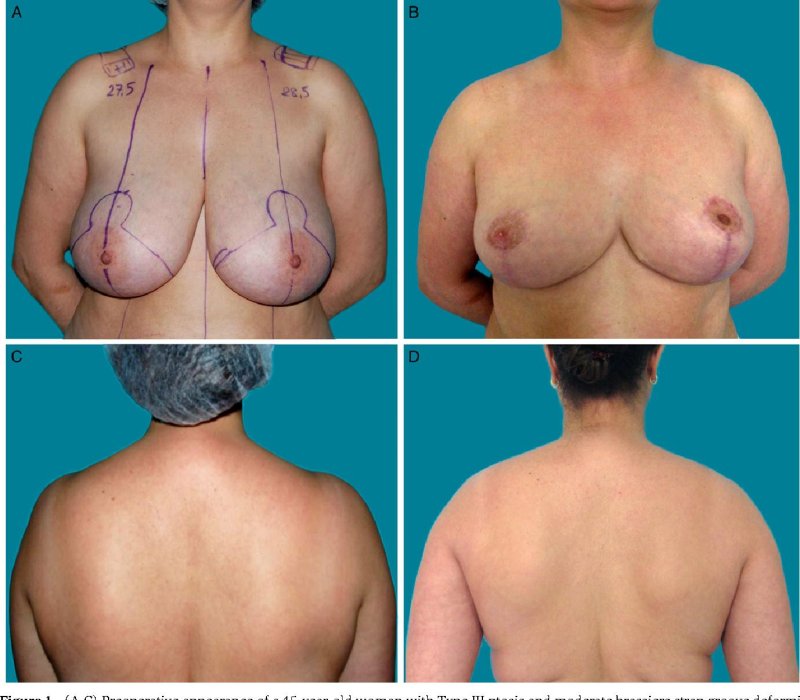 Breast reduction, Breast augmentation, Breast plastic