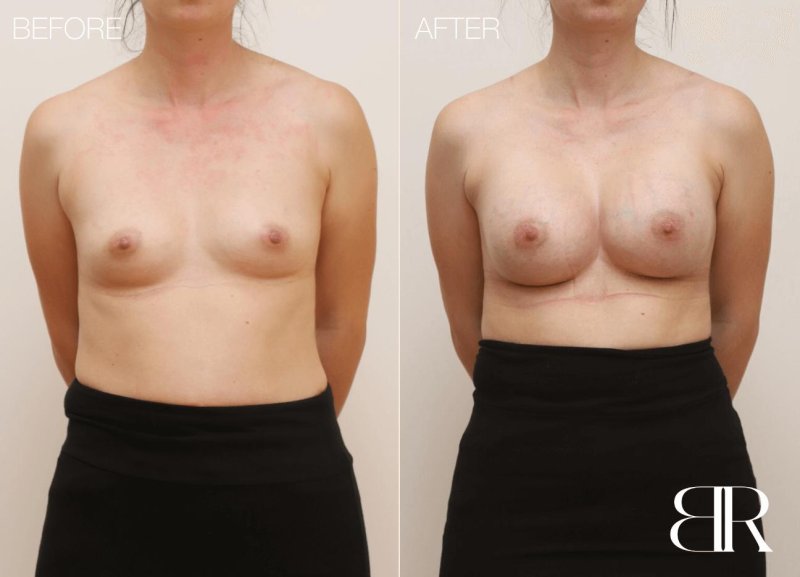 Breast augmentation, Breast plastic, Breast reduction dr richard