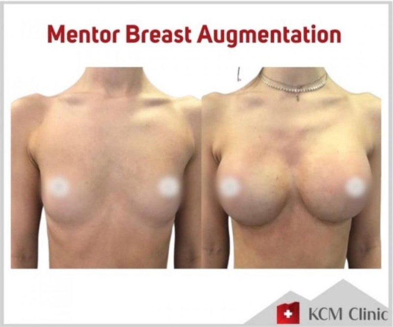 Breast enlargement, Before and after breast augmentation, Breast plastic