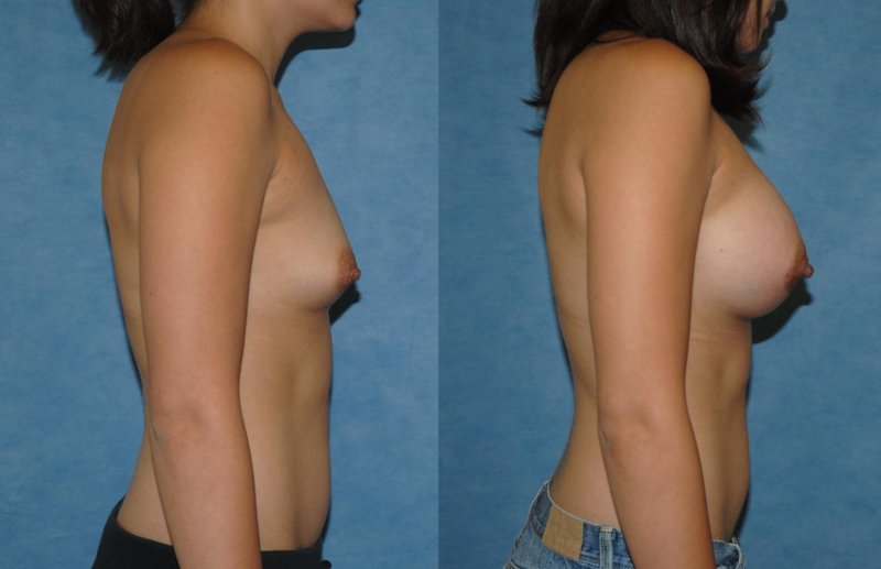 Breast enlargement, Breast reduction dr richard, Breast augmentation