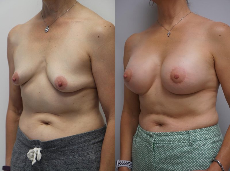 Breast plastic, For breast augmentation, Breast plastic surgery