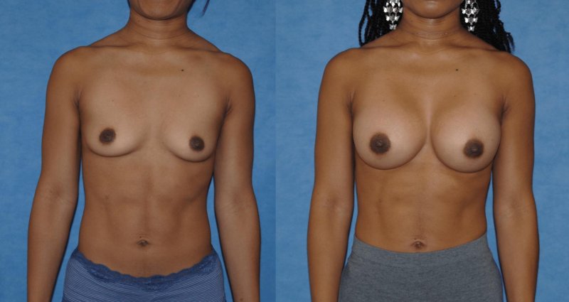 Breast augmentation, Breast reduction dr richard, Breast enlargement