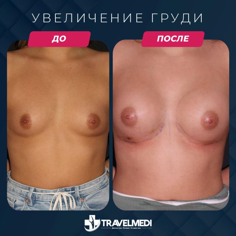 Before and after breast augmentation, Tits implants, Breast enlargement