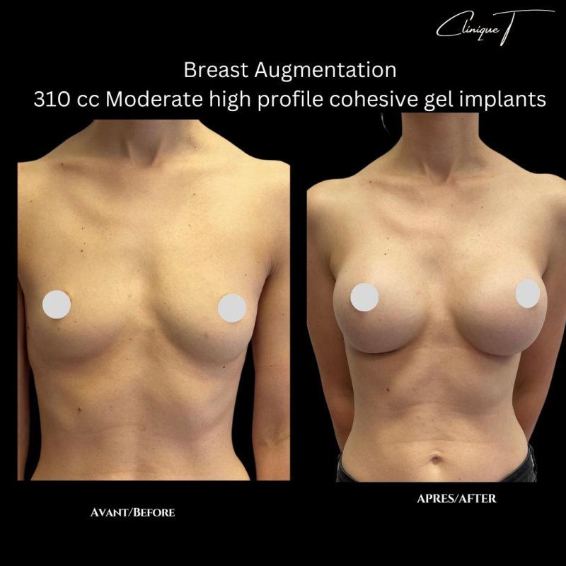 Breast augmentation, Breast implant, Breast plastic