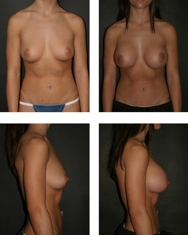 Naked chest of different shapes, Before and after breast augmentation, Breast enlargement