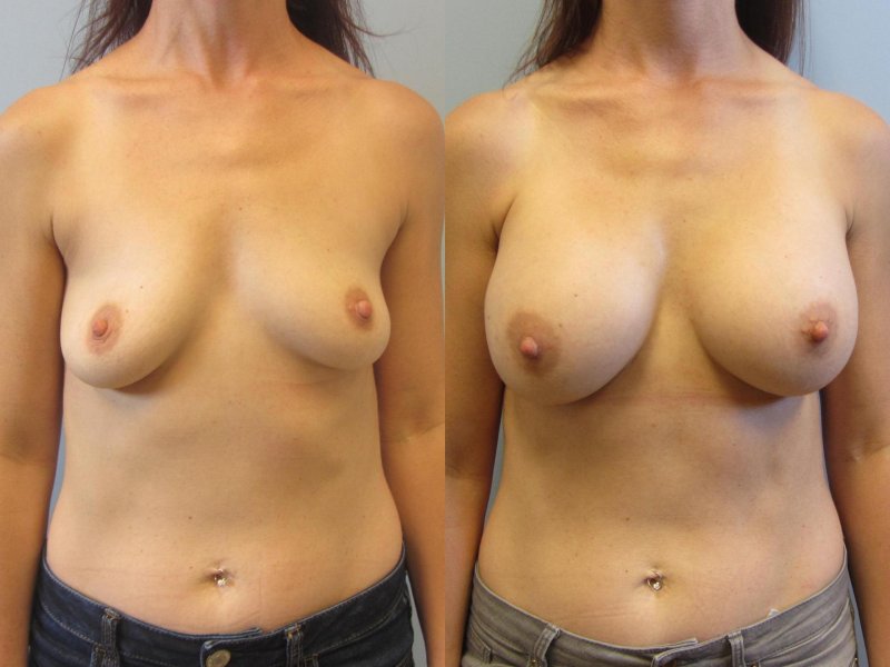 Perfect chest, Perfect tits, Breast plastic