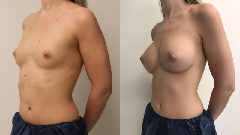 Breasts grow, Gynecomastia liposuction, Breast plastic