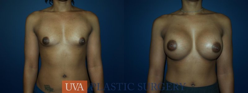 Breast augmentation, Breast implant, Breast reduction dr richard