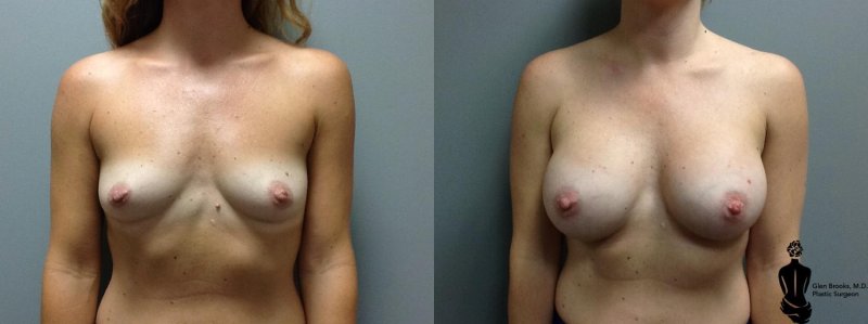 Breast augmentation, Breast reduction dr richard, Nikki benz before and after breast enhancement