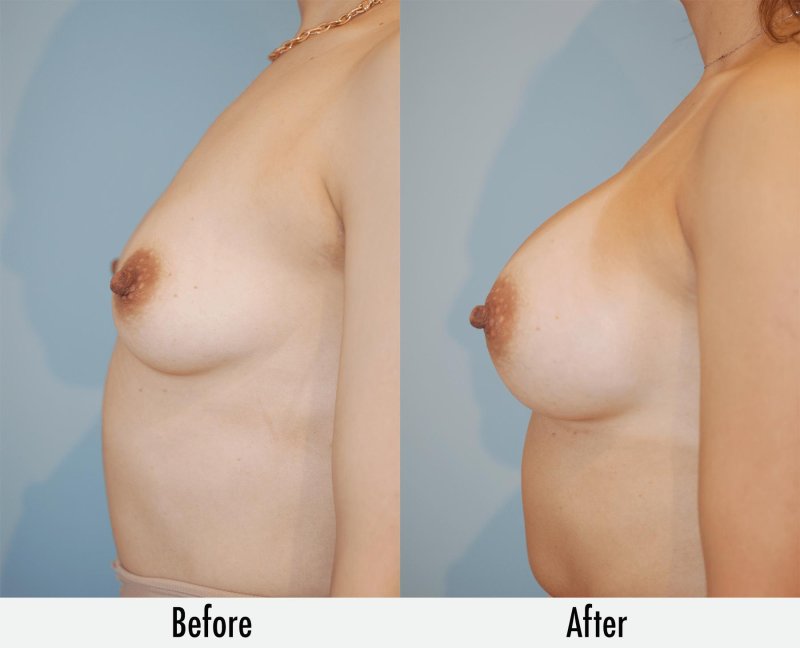Breast enlargement, Before and after breast augmentation, Breast plastic
