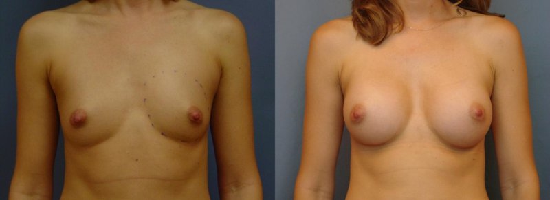 Breast reduction dr richard, Breast implant, Breast augmentation
