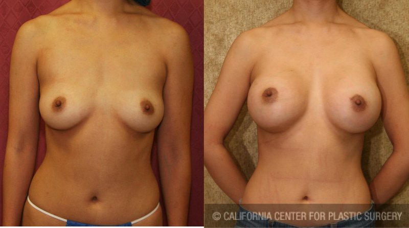 Breast augmentation, Breast plastic, Breast enlargement