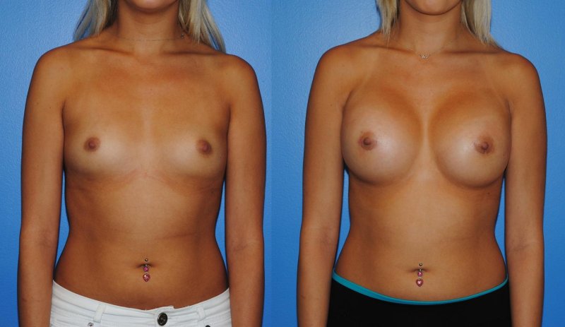 Breast enlargement, Breast augmentation, Before and after breast augmentation