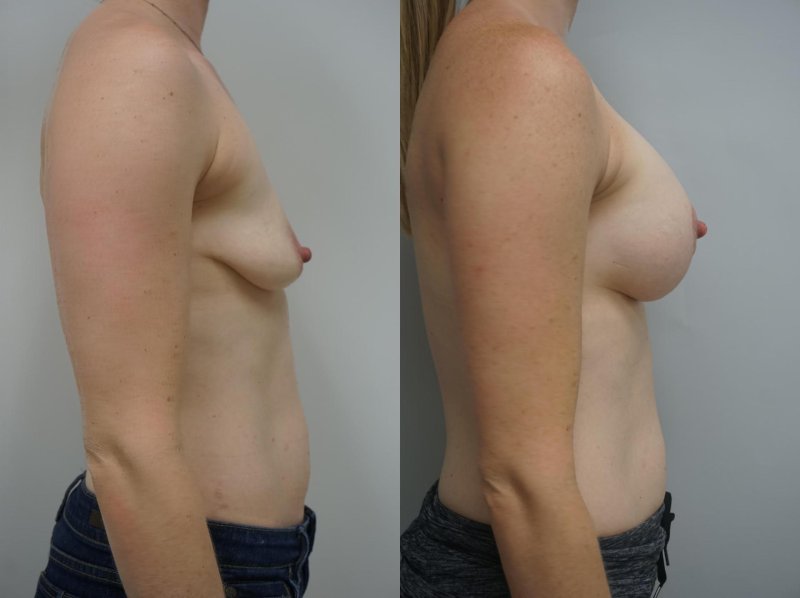 Breast augmentation, For breast augmentation, Before and after breast augmentation