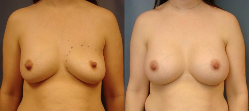 Breast enlargement, Gynecomastia liposuction, Breast augmentation