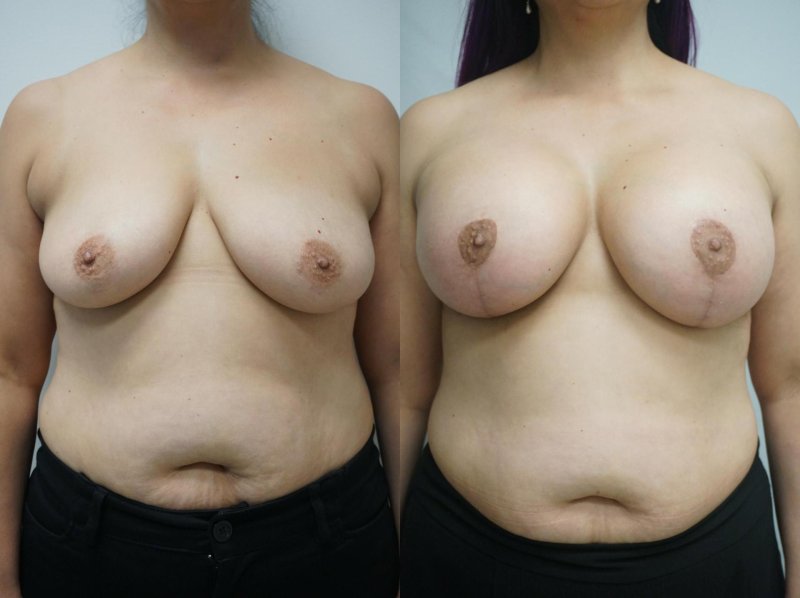 Breast plastic, Breast, Breast lipomolation